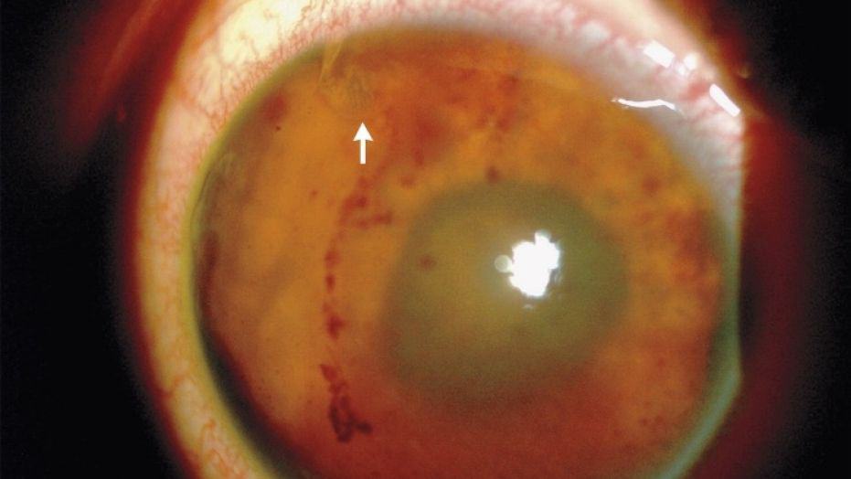Parasitic Worm eye