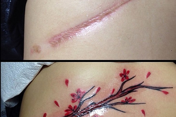 Tip 82+ about liver transplant scar tattoo best .vn